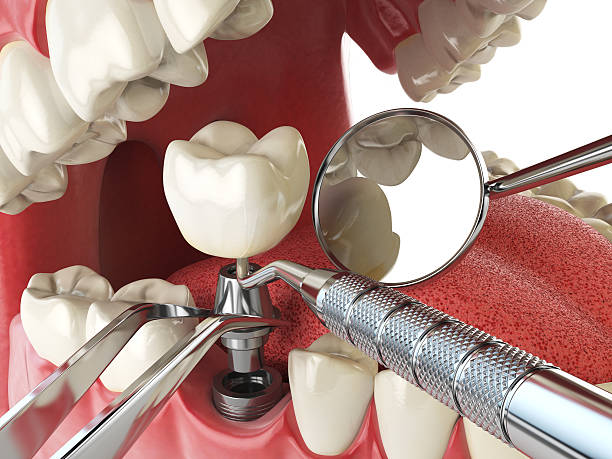 Best Emergency Denture Repair in Lake Brownwood, TX